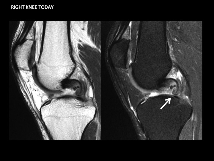 Figure 1 for case posteromedial bundle of posterior cruciate ligament ( RID2786 )